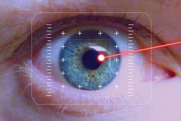 LASIK Surgery