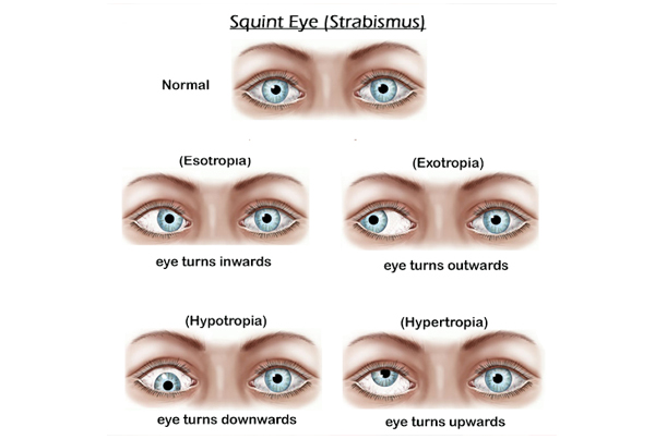 Squint Problems