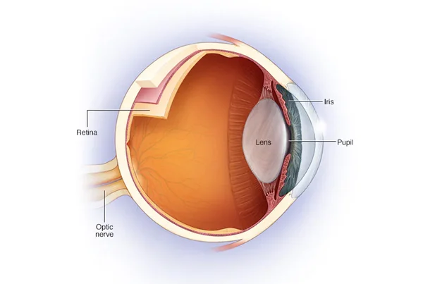 Optic Neuritis