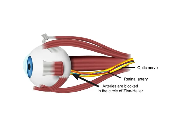 Optic Neuropathy