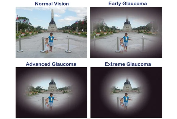 Glaucoma